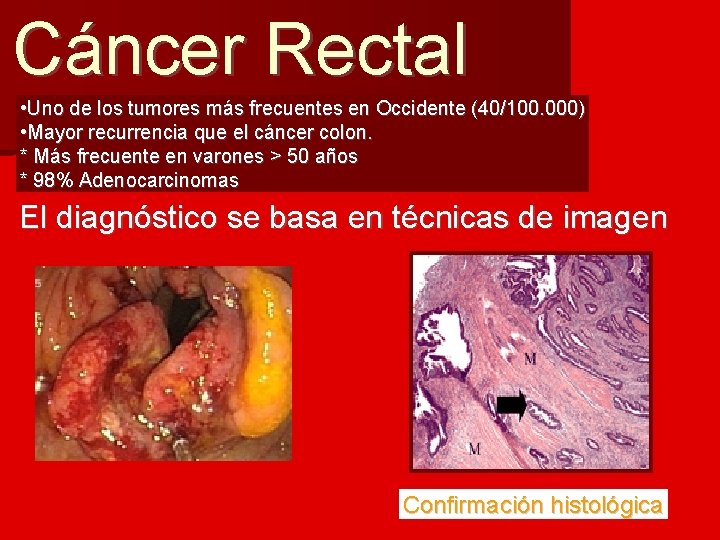 Cáncer Rectal • Uno de los tumores más frecuentes en Occidente (40/100. 000) •