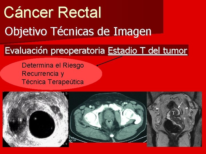 Cáncer Rectal Objetivo Técnicas de Imagen Evaluación preoperatoria Estadio T del tumor Determina el