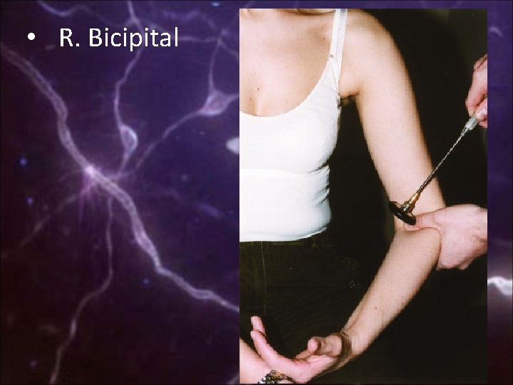  • R. Bicipital 