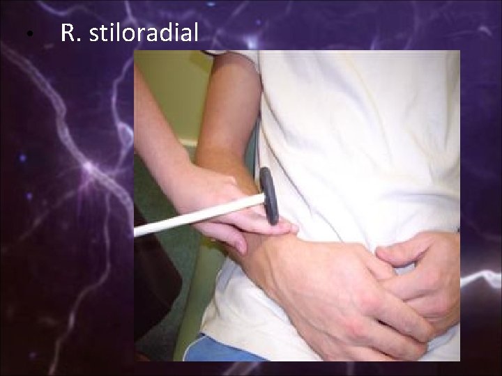  • R. stiloradial 