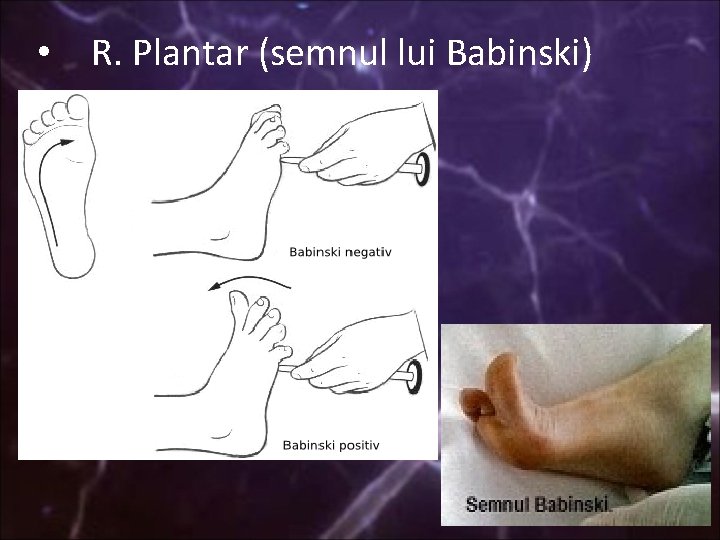  • R. Plantar (semnul lui Babinski) 