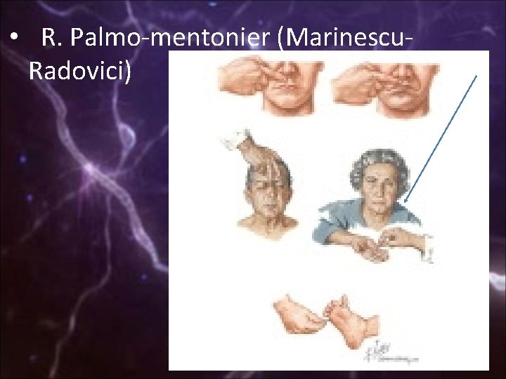  • R. Palmo-mentonier (Marinescu. Radovici) 