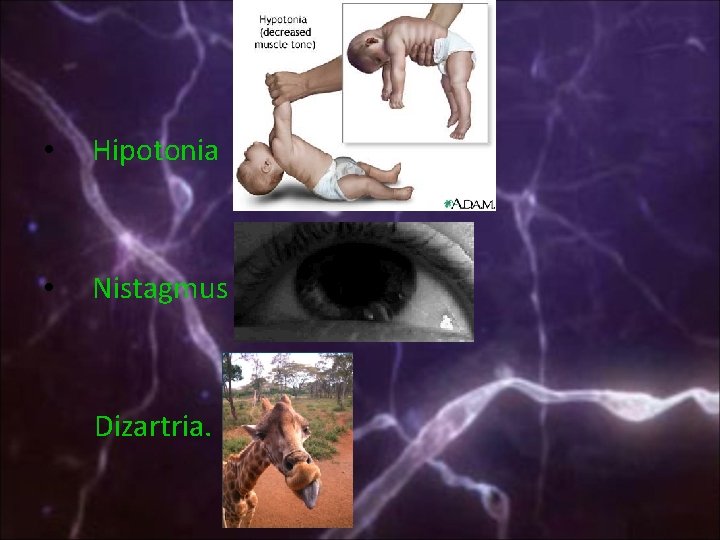  • Hipotonia • Nistagmus Dizartria. 