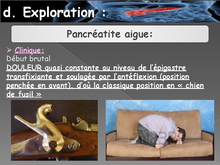 d. Exploration : Pancréatite aigue: Ø Clinique: Début brutal DOULEUR quasi constante au niveau
