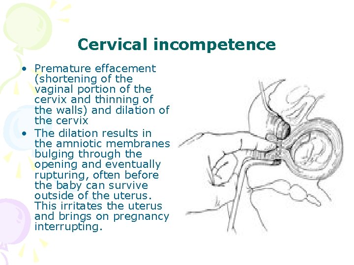 Cervical incompetence • Premature effacement (shortening of the vaginal portion of the cervix and