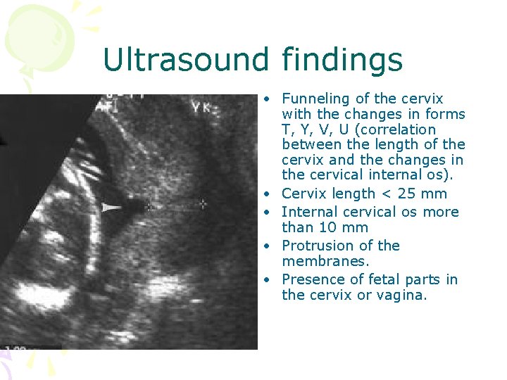 Ultrasound findings • Funneling of the cervix with the changes in forms T, Y,