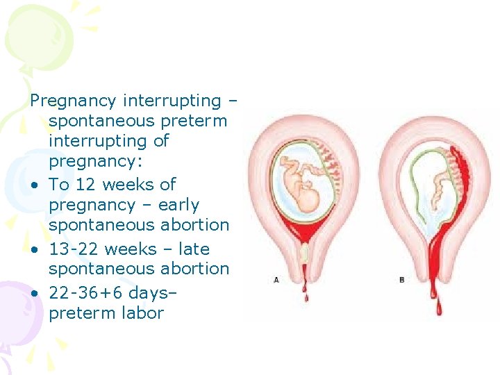 Pregnancy interrupting – spontaneous preterm interrupting of pregnancy: • To 12 weeks of pregnancy