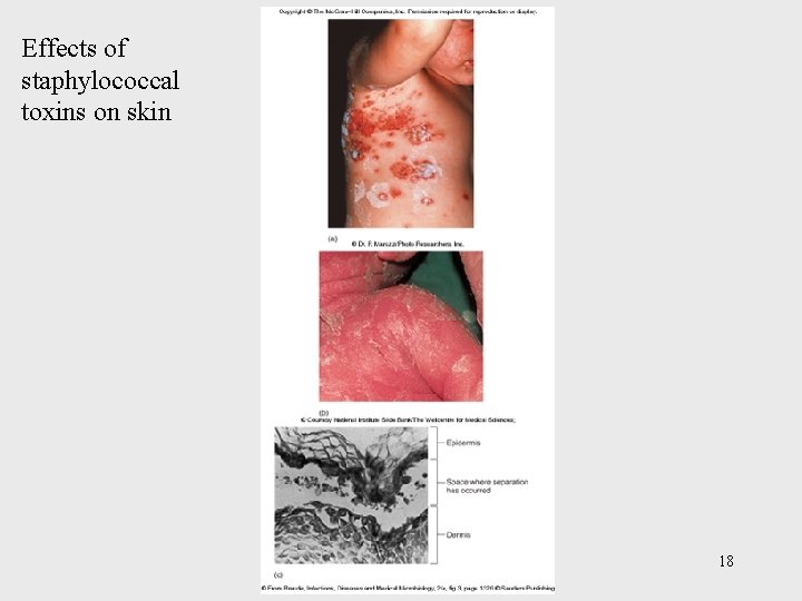 Effects of staphylococcal toxins on skin 18 