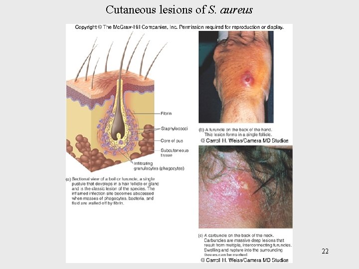 Cutaneous lesions of S. aureus 22 