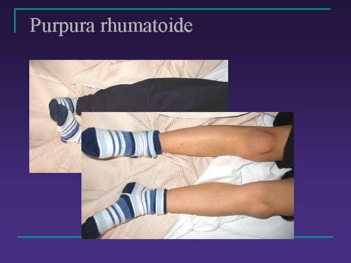 Purpura rhumatoide 