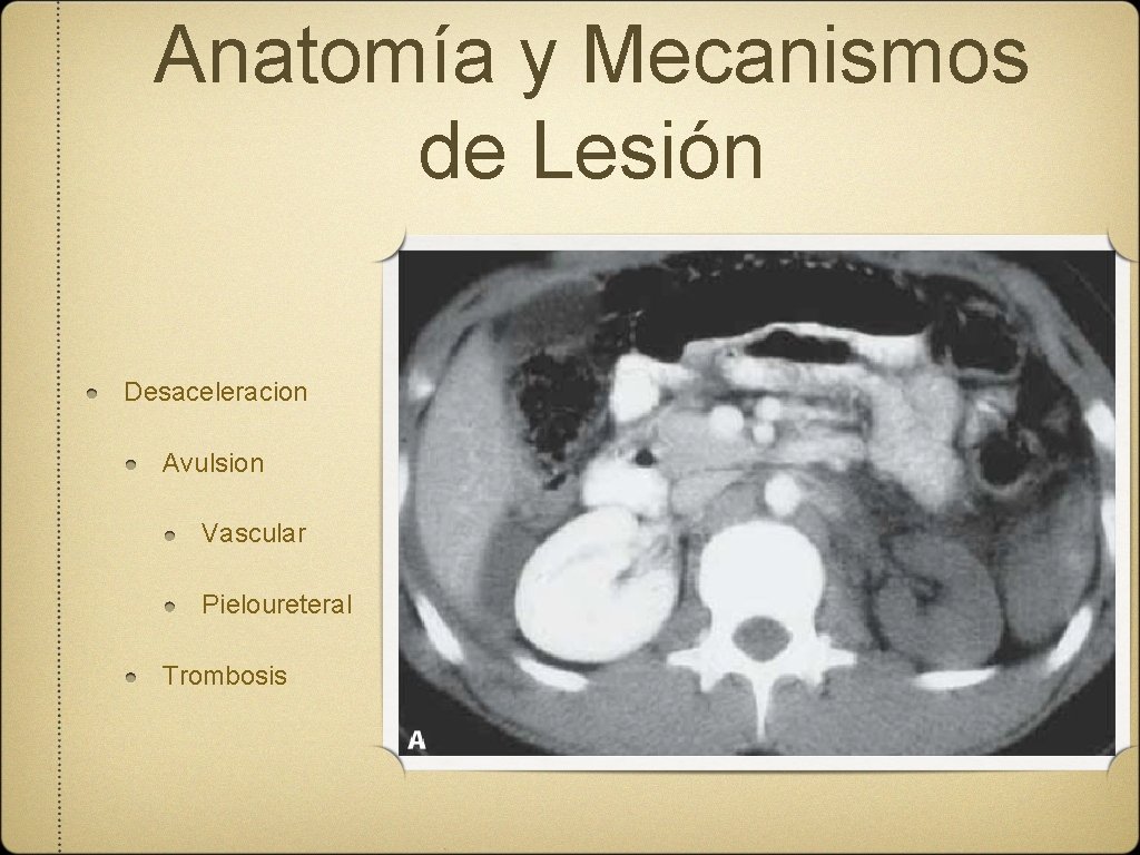 Anatomía y Mecanismos de Lesión Desaceleracion Avulsion Vascular Pieloureteral Trombosis 