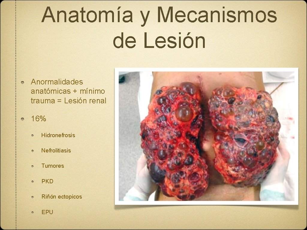 Anatomía y Mecanismos de Lesión Anormalidades anatómicas + mínimo trauma = Lesión renal 16%