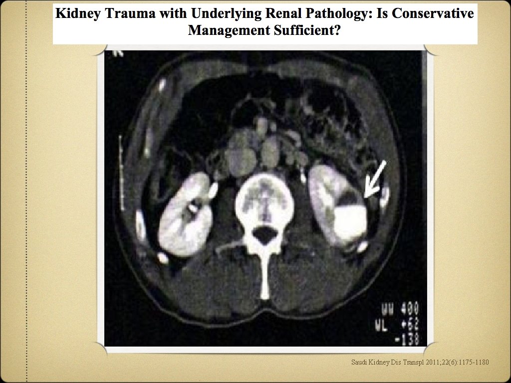 Saudi Kidney Dis Transpl 2011; 22(6): 1175 -1180 