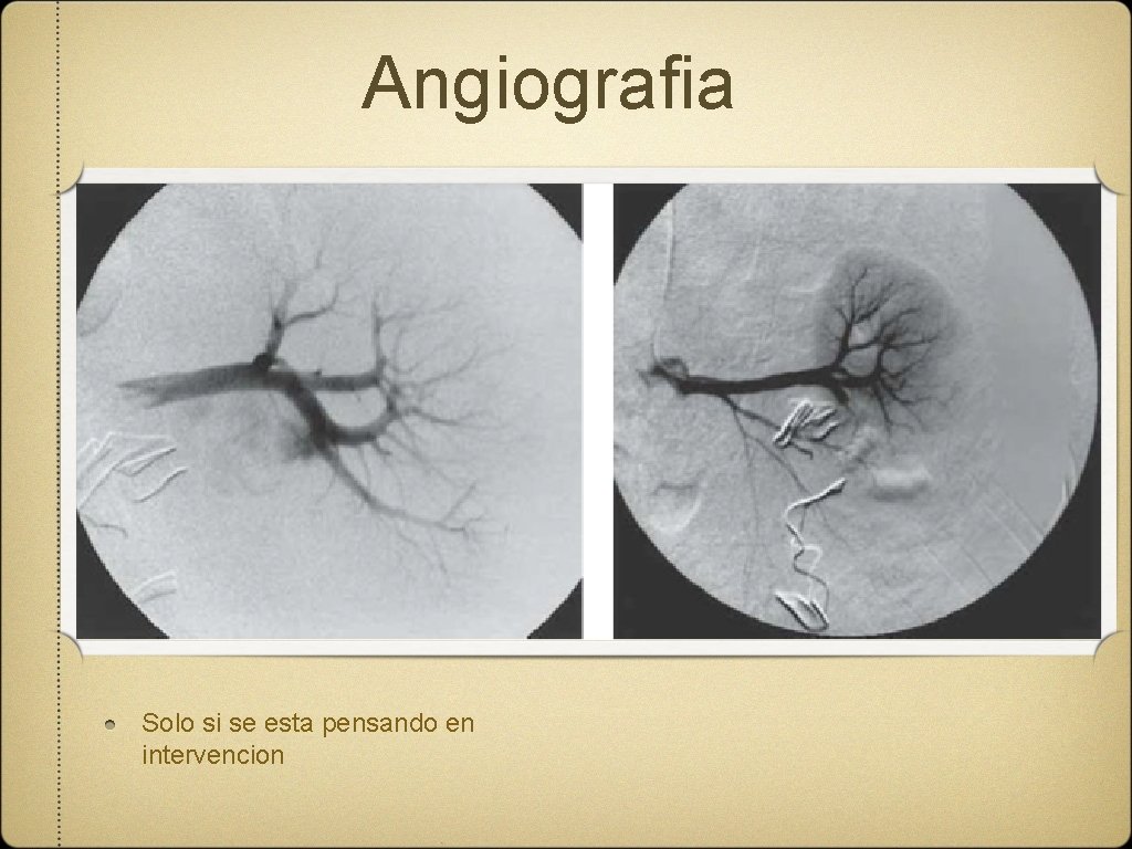 Angiografia Solo si se esta pensando en intervencion 