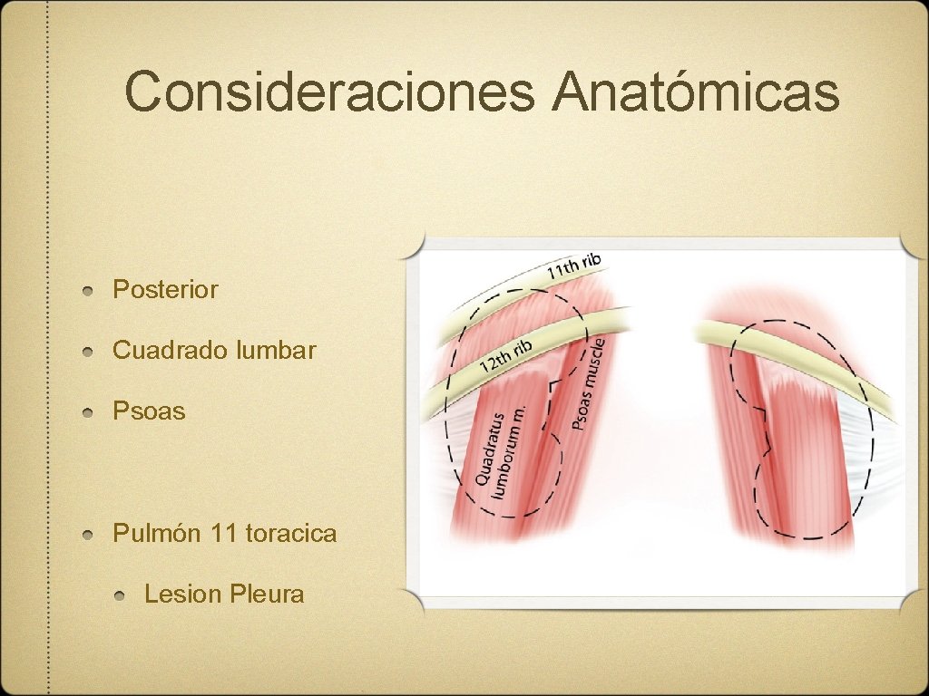 Consideraciones Anatómicas Posterior Cuadrado lumbar Psoas Pulmón 11 toracica Lesion Pleura 