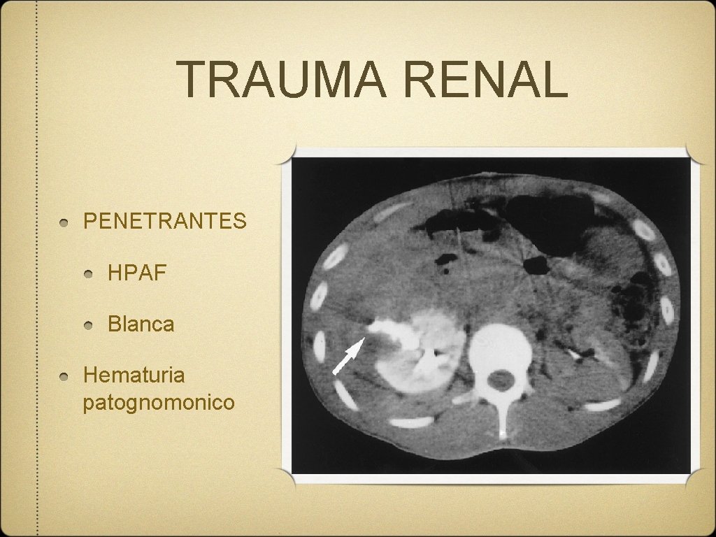 TRAUMA RENAL PENETRANTES HPAF Blanca Hematuria patognomonico 