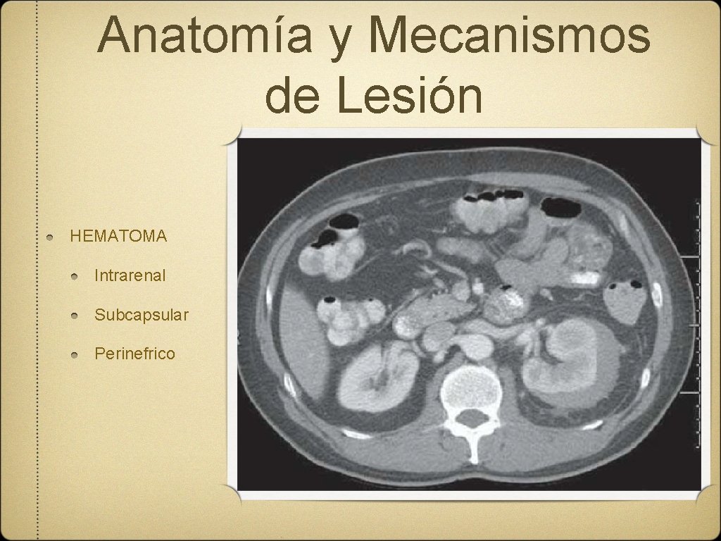 Anatomía y Mecanismos de Lesión HEMATOMA Intrarenal Subcapsular Perinefrico 
