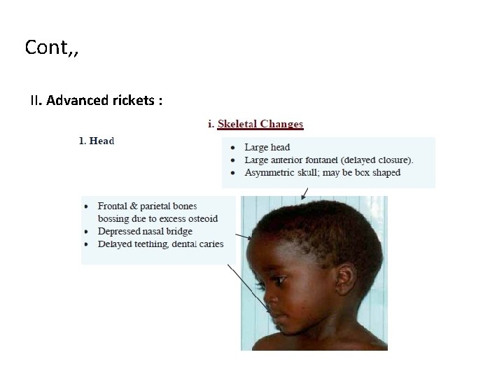 Cont, , II. Advanced rickets : 