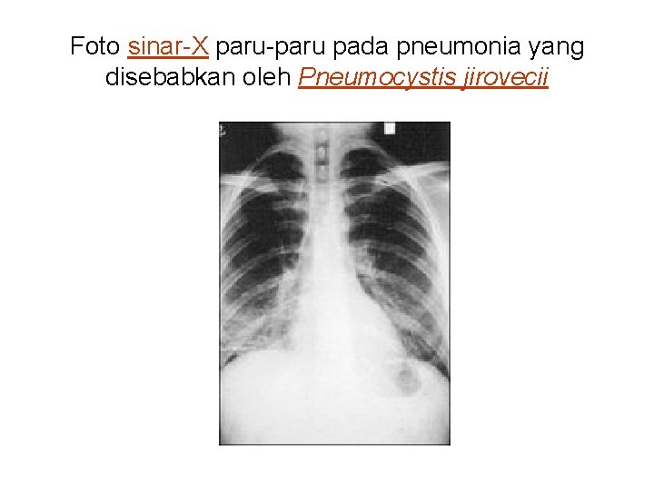 Foto sinar-X paru-paru pada pneumonia yang disebabkan oleh Pneumocystis jirovecii 