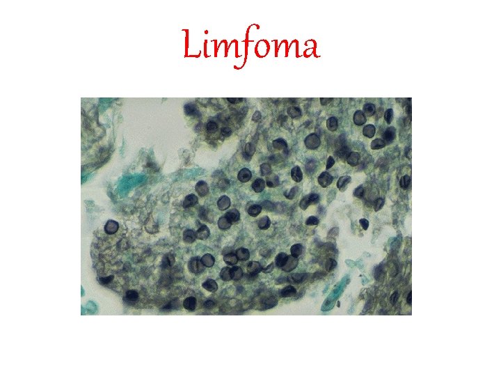 Limfoma 