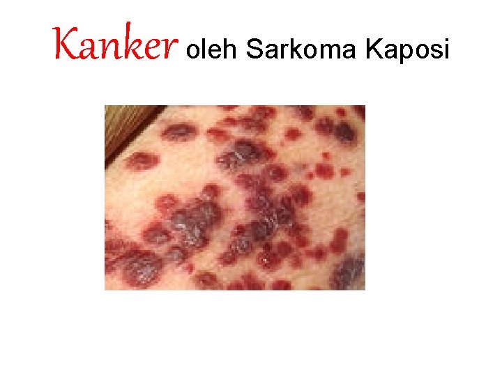 Kanker oleh Sarkoma Kaposi 