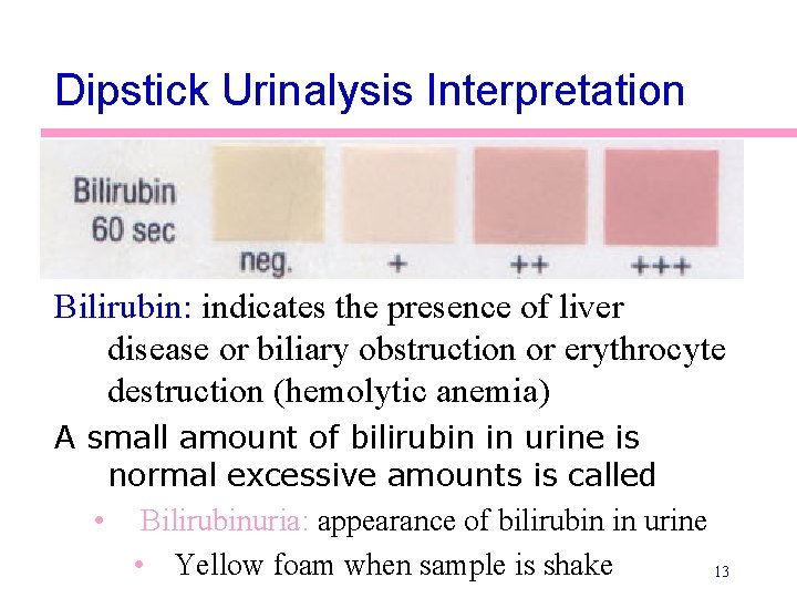 Dipstick Urinalysis Interpretation Bilirubin: indicates the presence of liver disease or biliary obstruction or