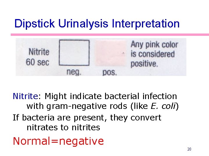 Dipstick Urinalysis Interpretation Nitrite: Might indicate bacterial infection with gram-negative rods (like E. coli)