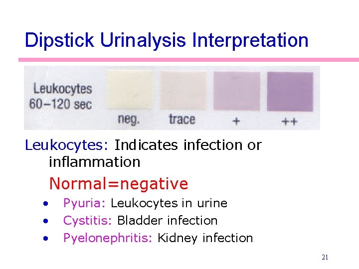 Dipstick Urinalysis Interpretation Leukocytes: Indicates infection or inflammation Normal=negative • • • Pyuria: Leukocytes