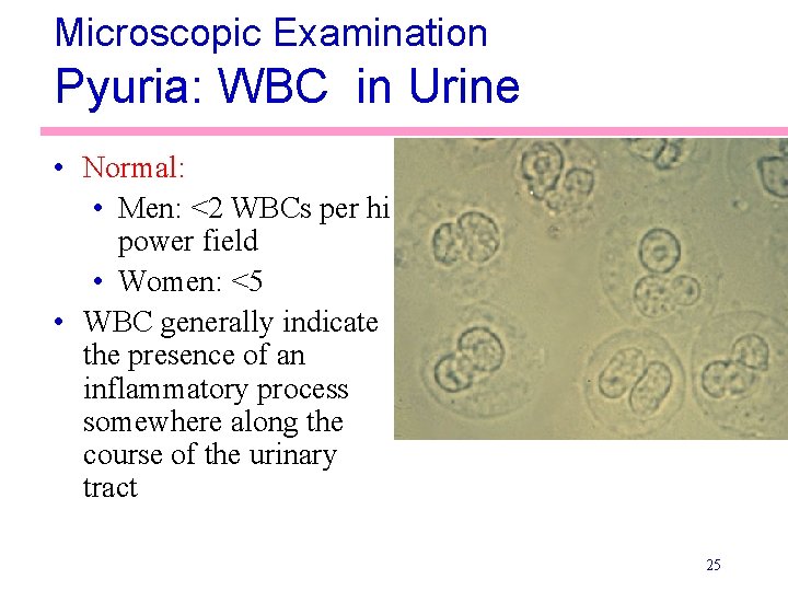 Microscopic Examination Pyuria: WBC in Urine • Normal: • Men: <2 WBCs per hi