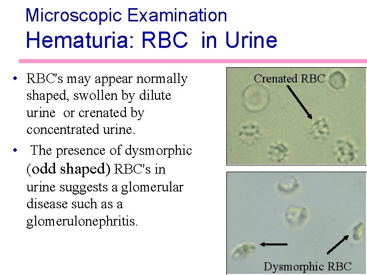 Microscopic Examination Hematuria: RBC in Urine • RBC's may appear normally shaped, swollen by