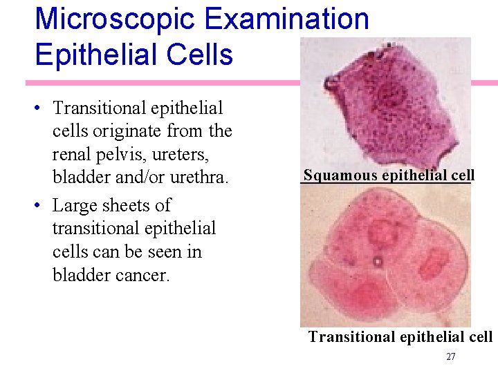 Microscopic Examination Epithelial Cells • Transitional epithelial cells originate from the renal pelvis, ureters,
