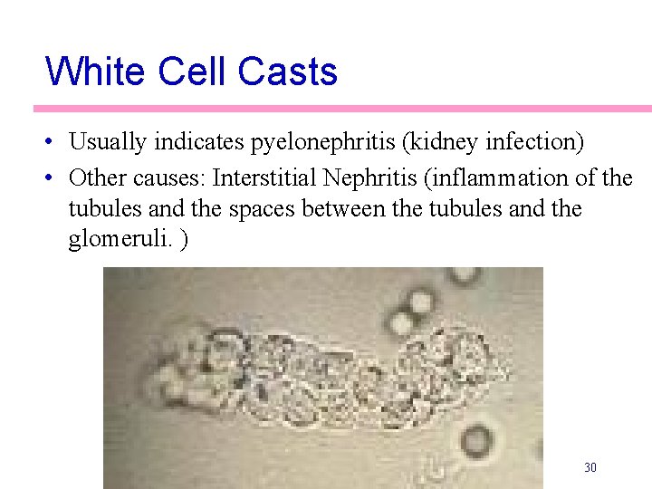 White Cell Casts • Usually indicates pyelonephritis (kidney infection) • Other causes: Interstitial Nephritis