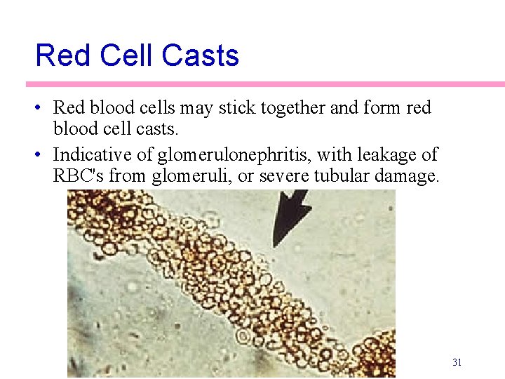 Red Cell Casts • Red blood cells may stick together and form red blood