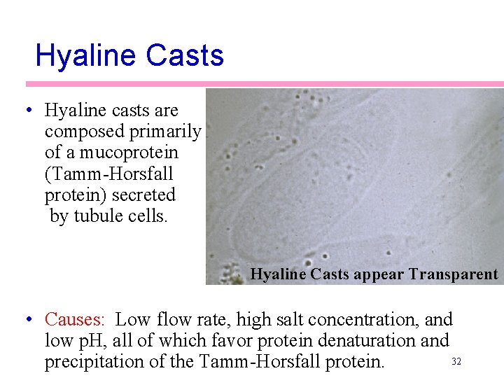 Hyaline Casts • Hyaline casts are composed primarily of a mucoprotein (Tamm-Horsfall protein) secreted