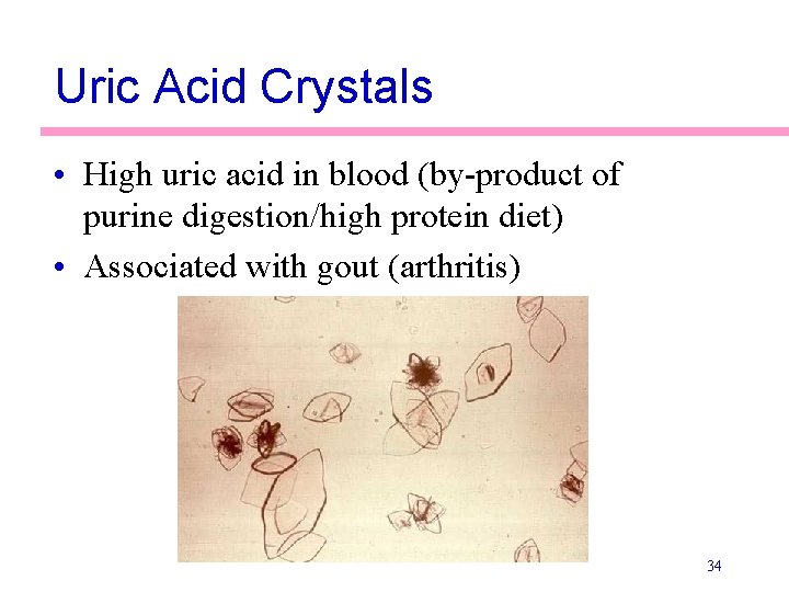 Uric Acid Crystals • High uric acid in blood (by-product of purine digestion/high protein