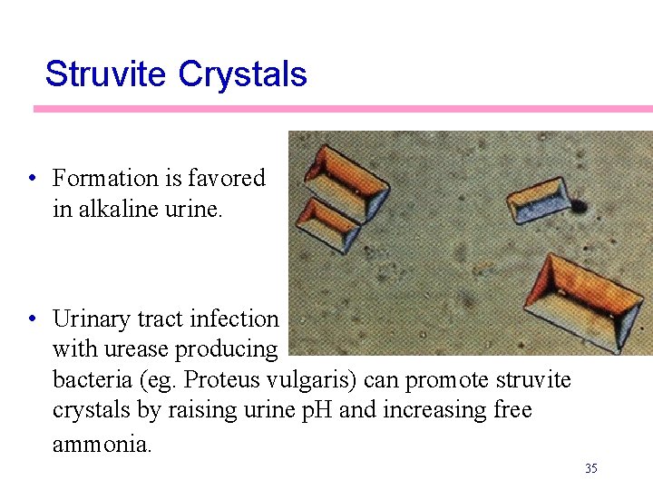 Struvite Crystals • Formation is favored in alkaline urine. • Urinary tract infection with
