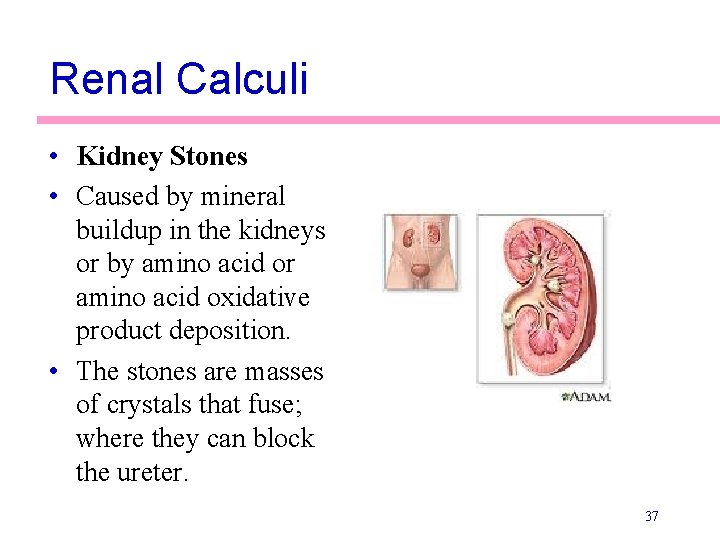 Renal Calculi • Kidney Stones • Caused by mineral buildup in the kidneys or