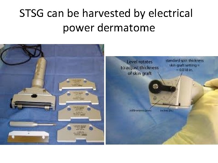 STSG can be harvested by electrical power dermatome 