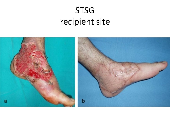 STSG recipient site 