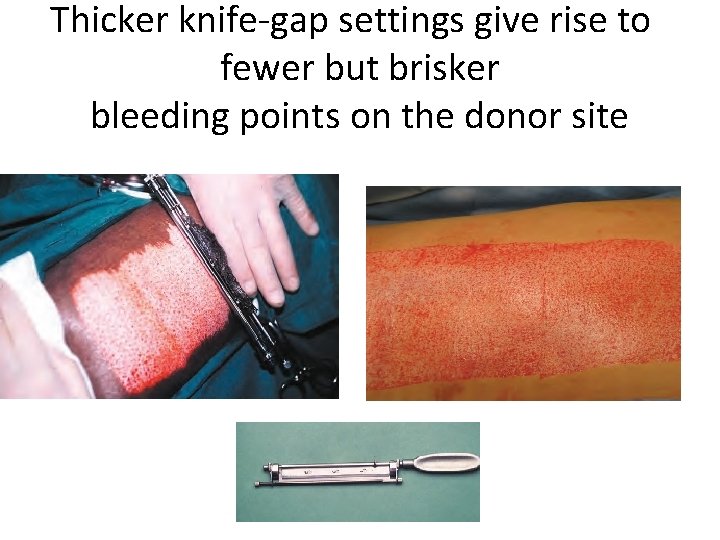 Thicker knife-gap settings give rise to fewer but brisker bleeding points on the donor