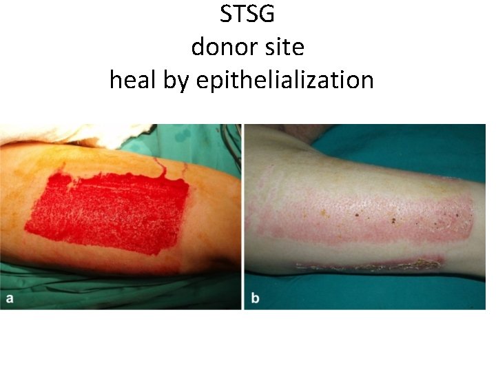 STSG donor site heal by epithelialization 