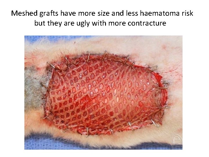 Meshed grafts have more size and less haematoma risk but they are ugly with