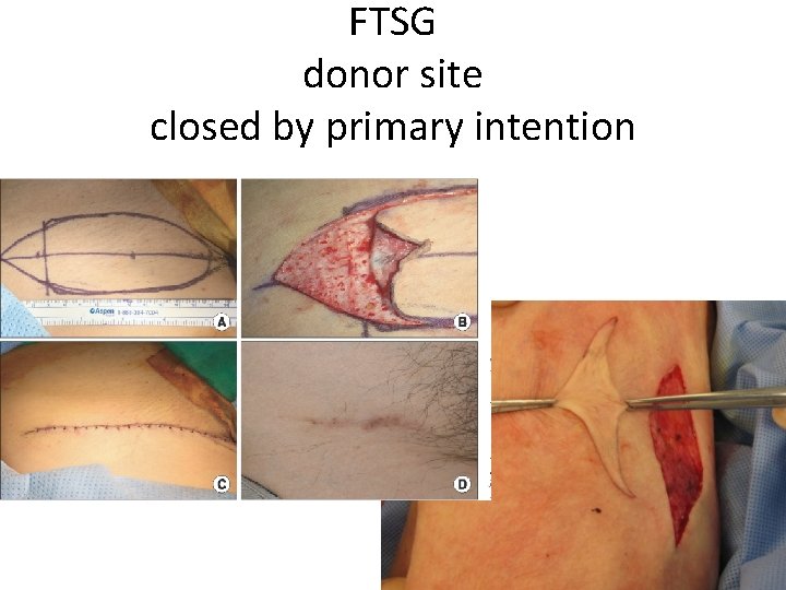 FTSG donor site closed by primary intention 
