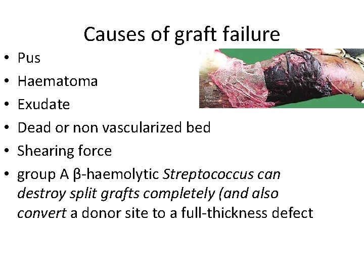 Causes of graft failure • • • Pus Haematoma Exudate Dead or non vascularized