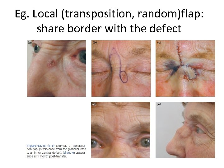 Eg. Local (transposition, random)flap: share border with the defect 