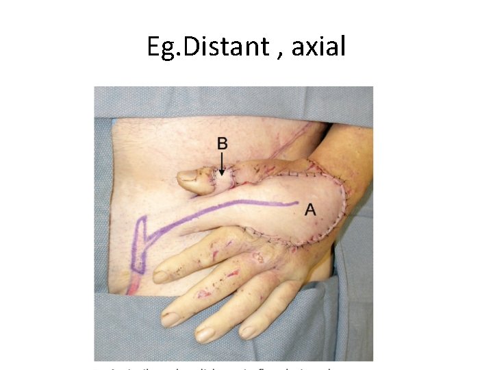 Eg. Distant , axial 