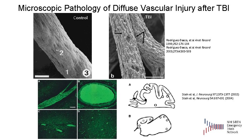 Microscopic Pathology of Diffuse Vascular Injury after TBI Control TBI Rodriguez-Baeza, et al Anat