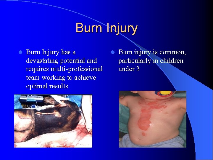 Burn Injury l Burn Injury has a l Burn injury is common, devastating potential