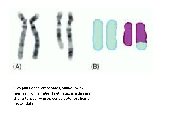 Two pairs of chromosomes, stained with Giemsa, from a patient with ataxia, a disease