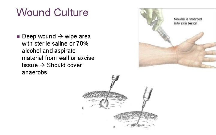 Wound Culture n Deep wound wipe area with sterile saline or 70% alcohol and